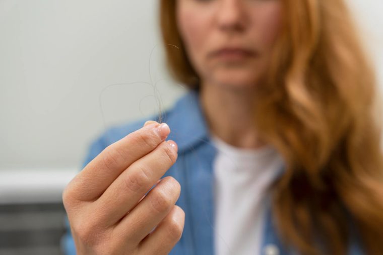 alopecia frontal mujeres